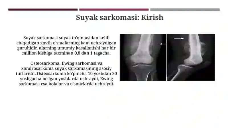 Suyaksarkomasi 3