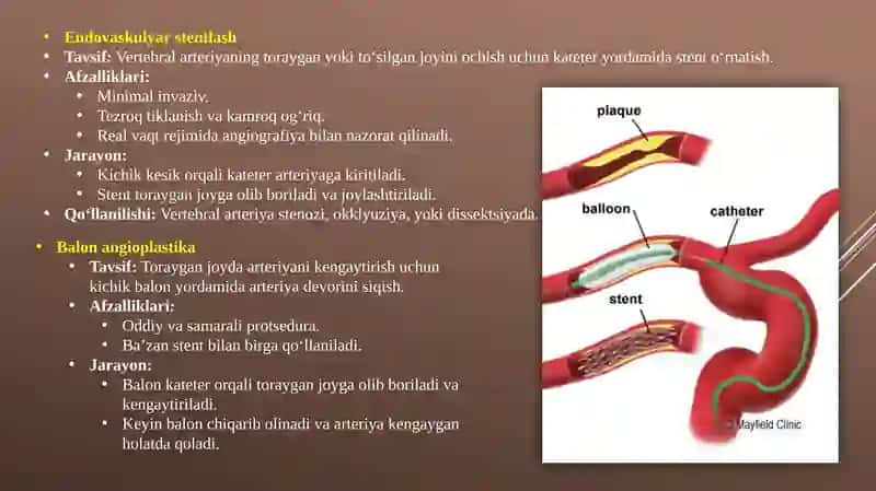 Vertebralarteriya operatsiyasi 3