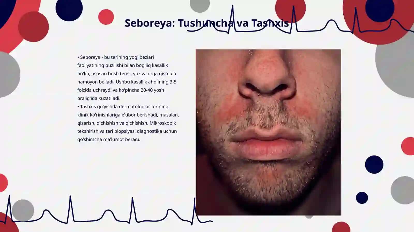 Seboreya 3
