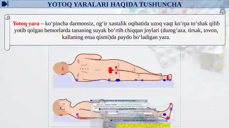 Yotоq yаrаlаri davоlаsh 3