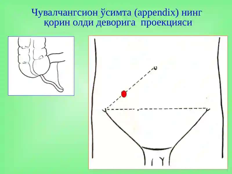 Ўткир аппендицит 3