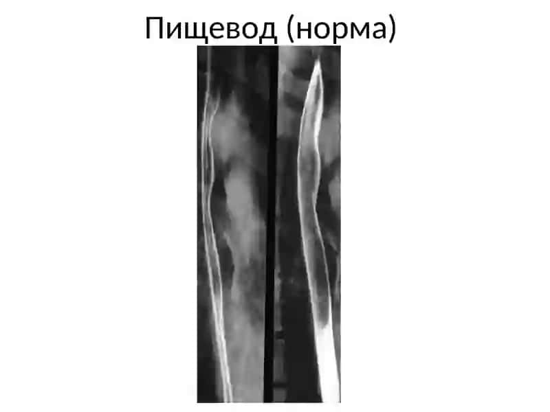 Лучевая диагностика заболеваний желудочно кишечного тракта 3