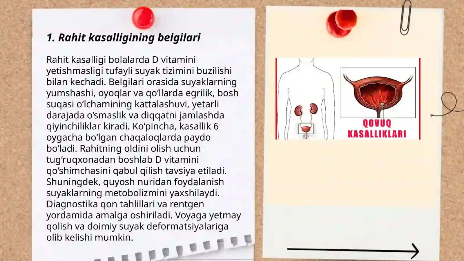 Bolalarda rahit kasalligi 3