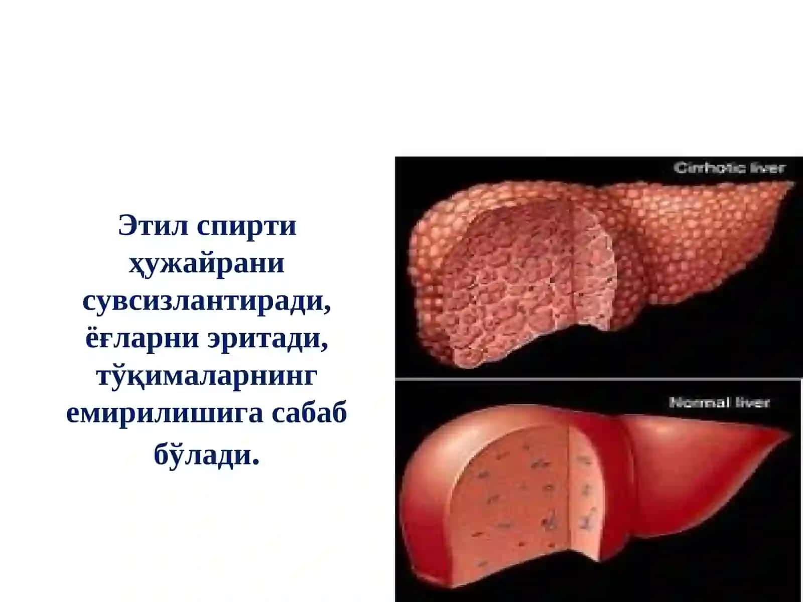Спиртли ичимликнинг зарари 3
