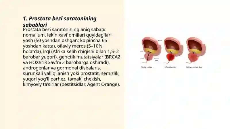 Prostata bezi saratoni 3