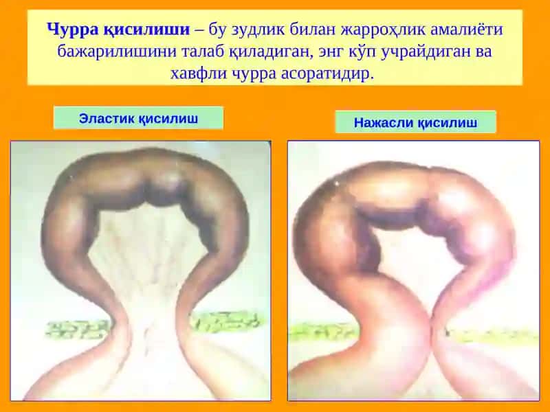 Чурранинг асоратлари 3