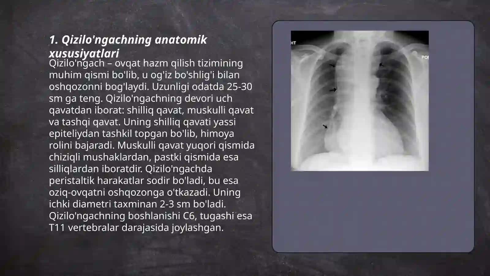 Qizilo'ngach kasalliklarining rentgenografiyasi 3