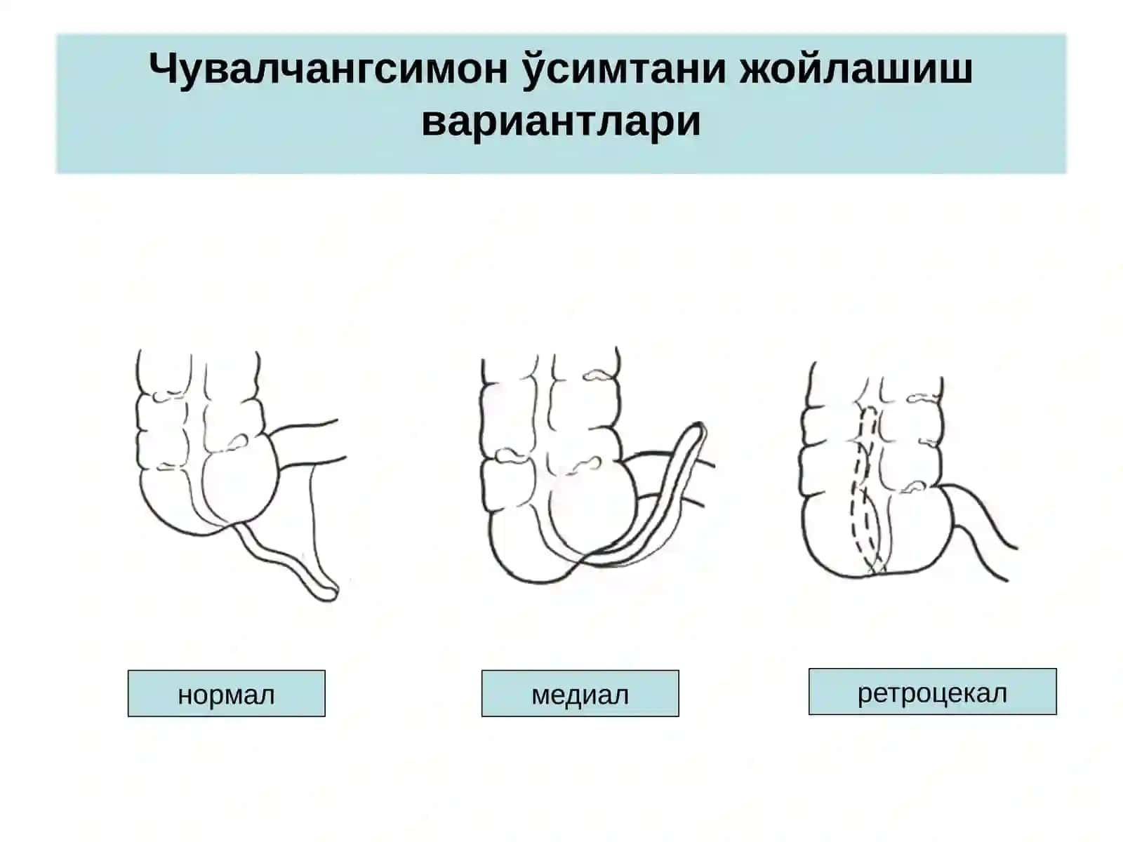 Ўткир аппендицит-чувалчангсимон ўсимтанинг ўткири носпецифик яллиғланиши 3