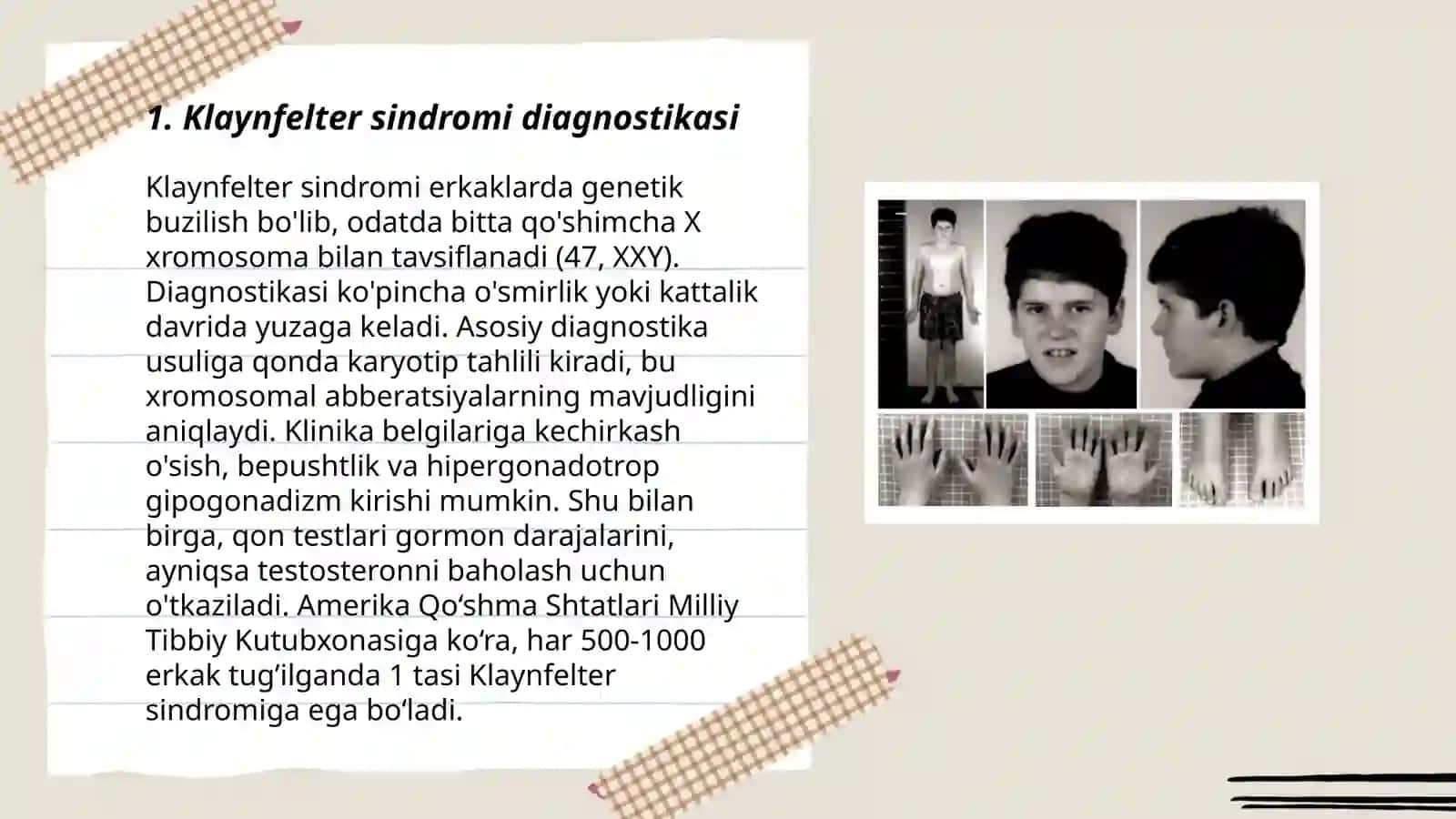 Klaynfelter sindromi 3