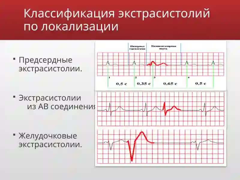 Экстрасистолии 3