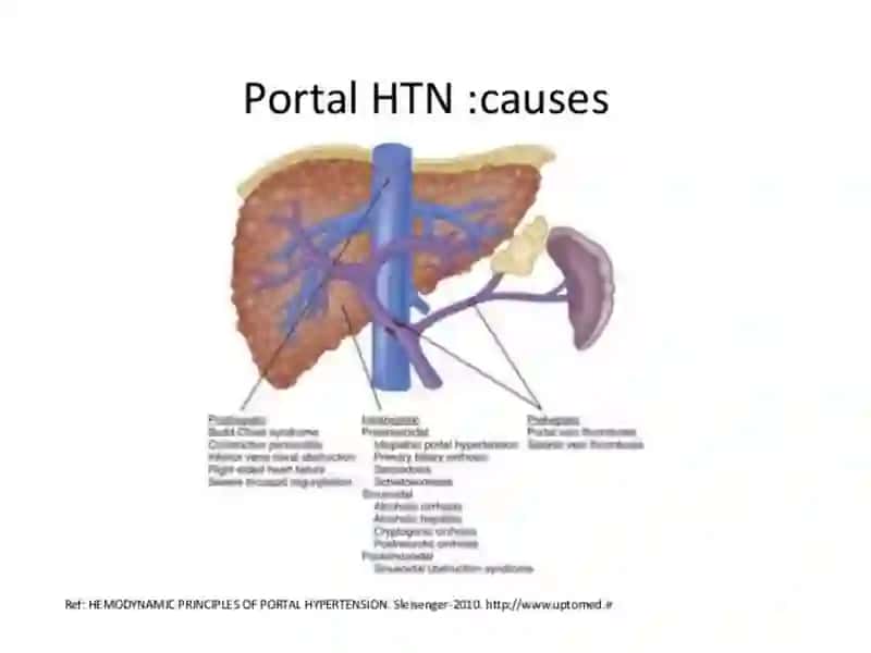 Portal Hypertension 3
