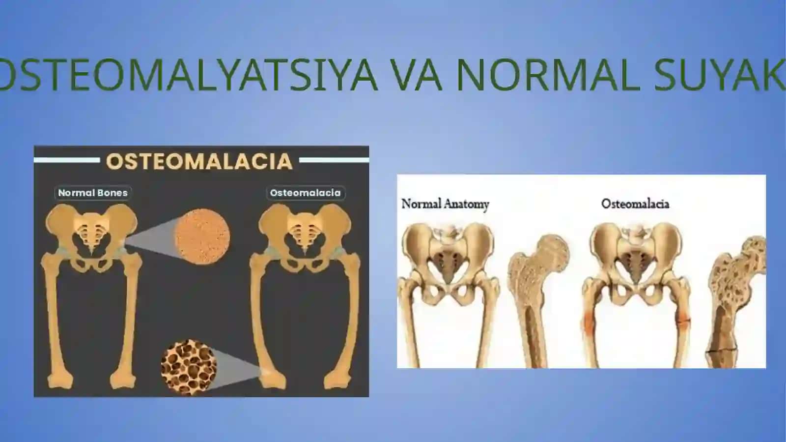 Osteomalyatsiya 3