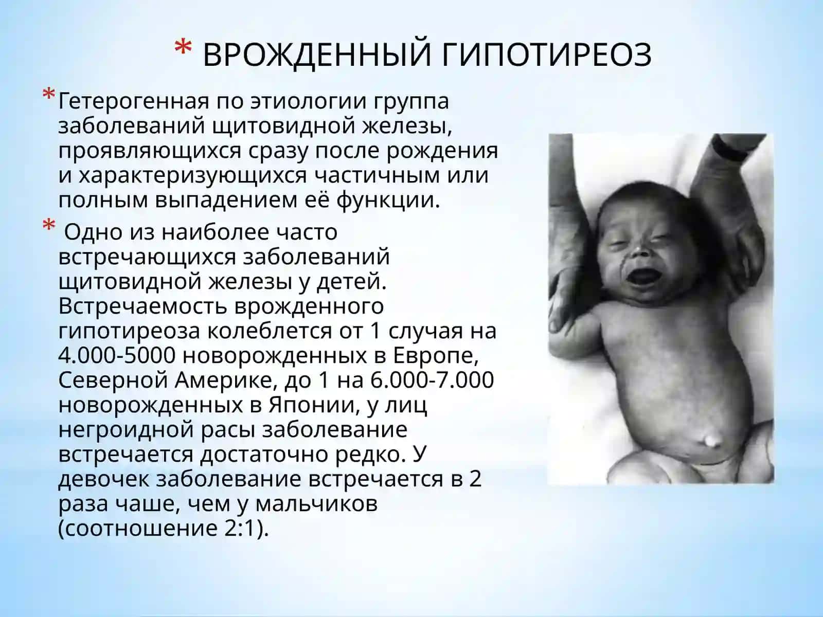 Врожденный гипотиреоз 3