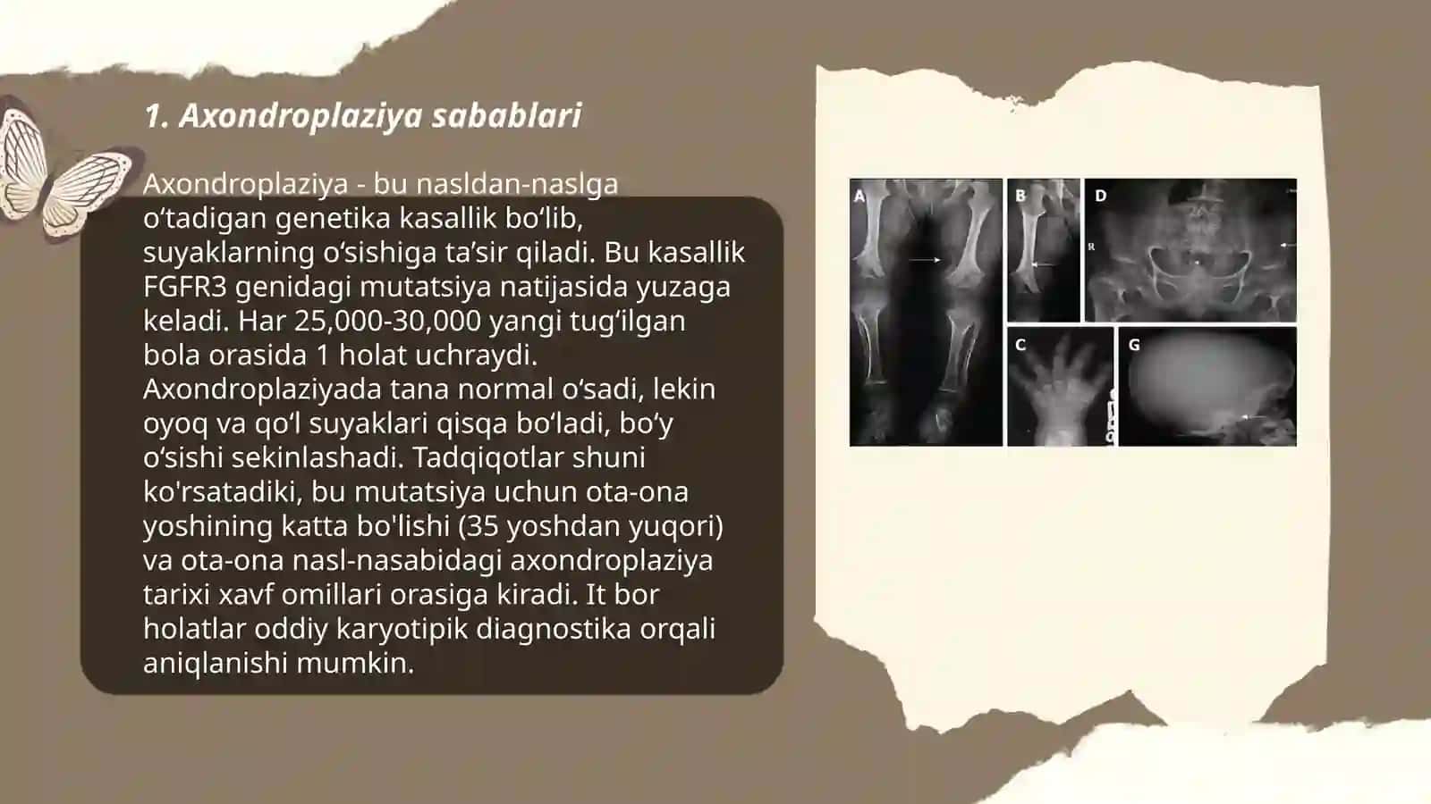 Axondroplaziya 3