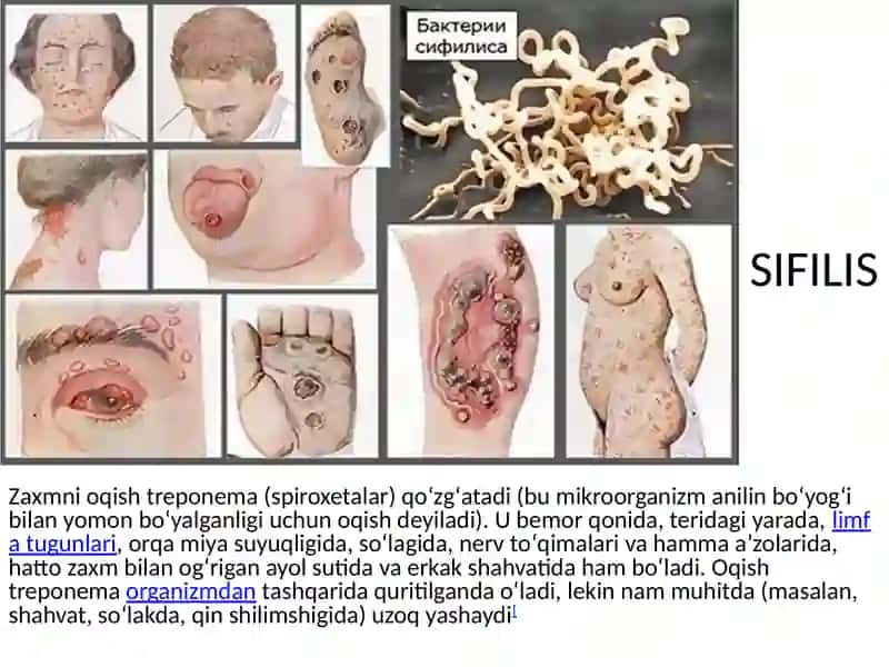 YUQUMLI KASALLIKLAR PATOLOGIK ANATOMIYASI 3
