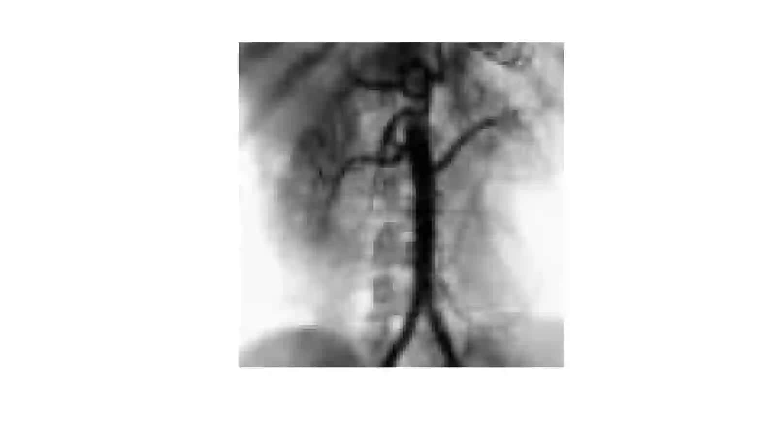 Angiografiya 3