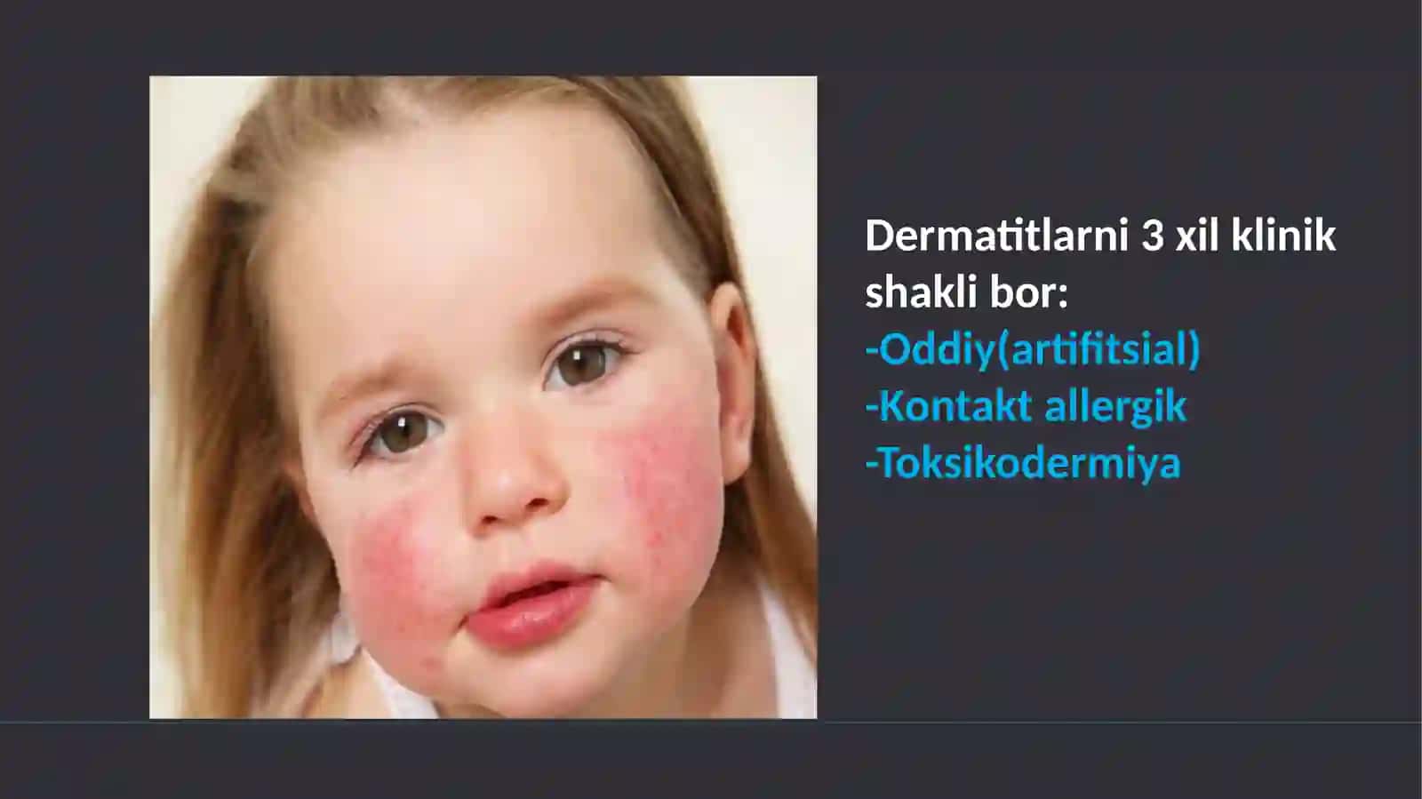 Oddiy va allergik kontakt dermatit. Toksik-allergik dermatit. Ekzema 3