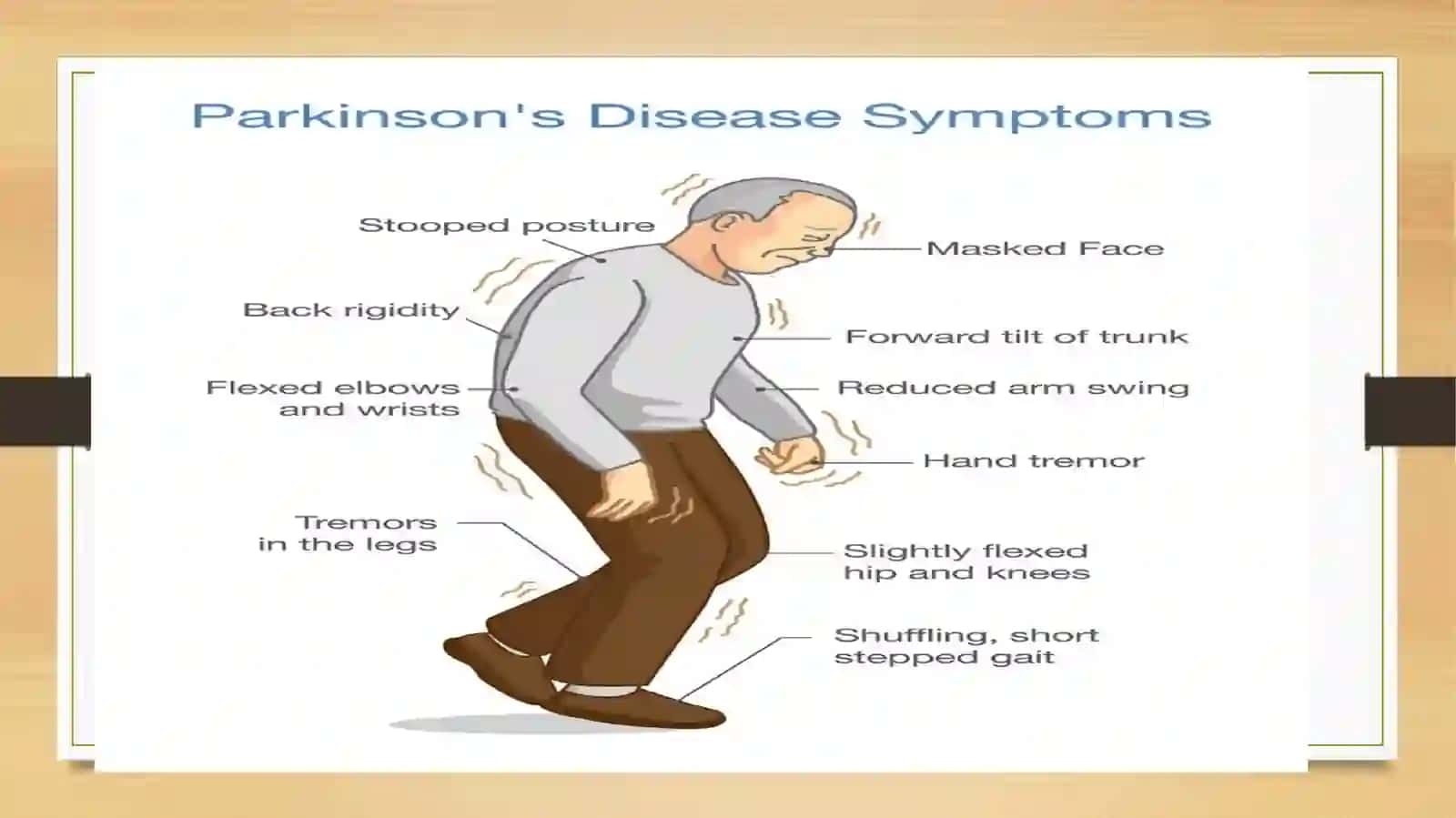 Parkinsonkasalligini davolashda ishlatiladigan dorivoshlar 3