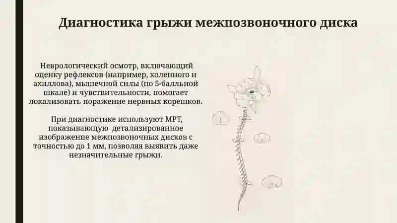 Диагностика грыжи межпозвонкового диска 3