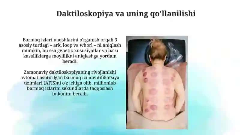 Dermatoglifika. Daktiloskopiya. Turli irsiy kasalliklarda dermatoglifik 3