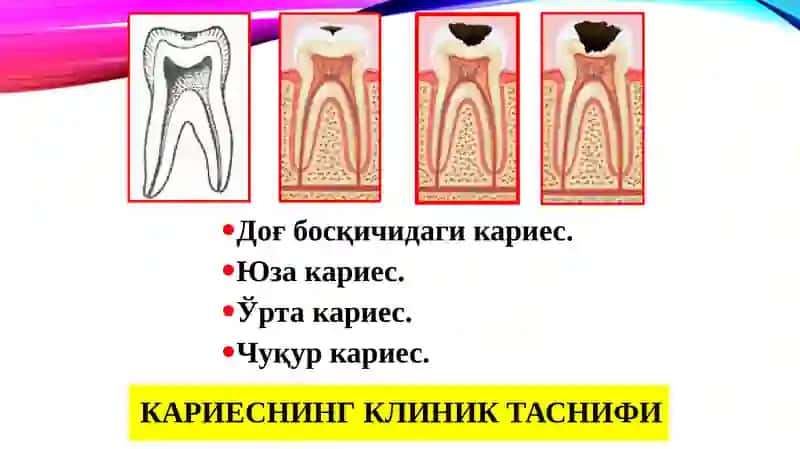 Чархлашнинг минималинвазив усуллари 3