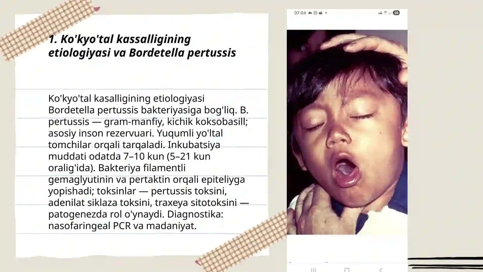Ko'kyo'tal kassalligi 3