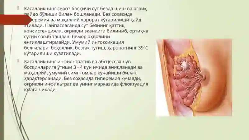 Мастит-Сутбези 3