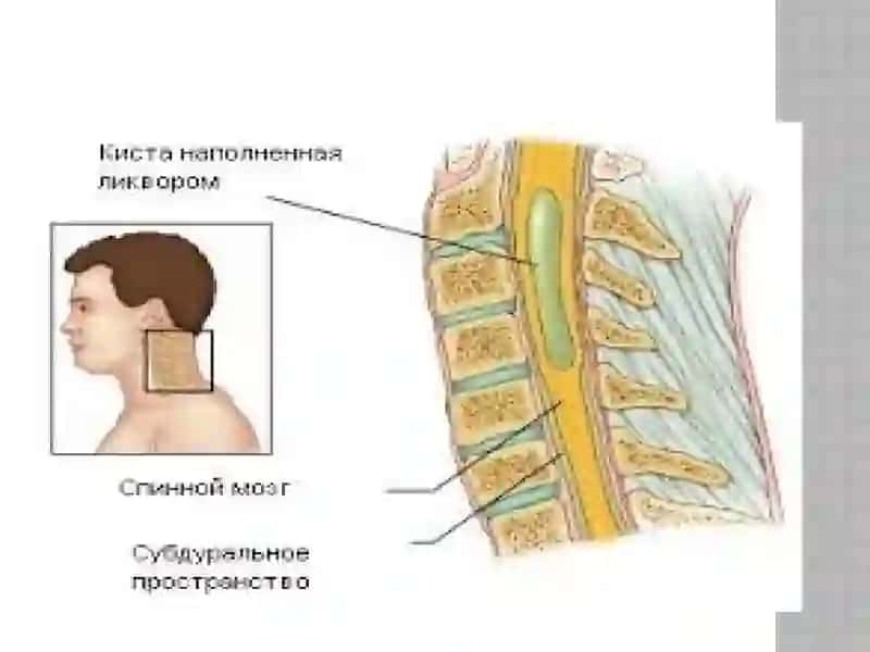 Siringomiyeliya 3