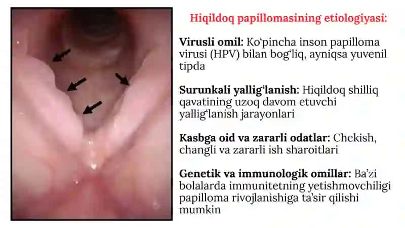 Hiqildoq papillomasi 3