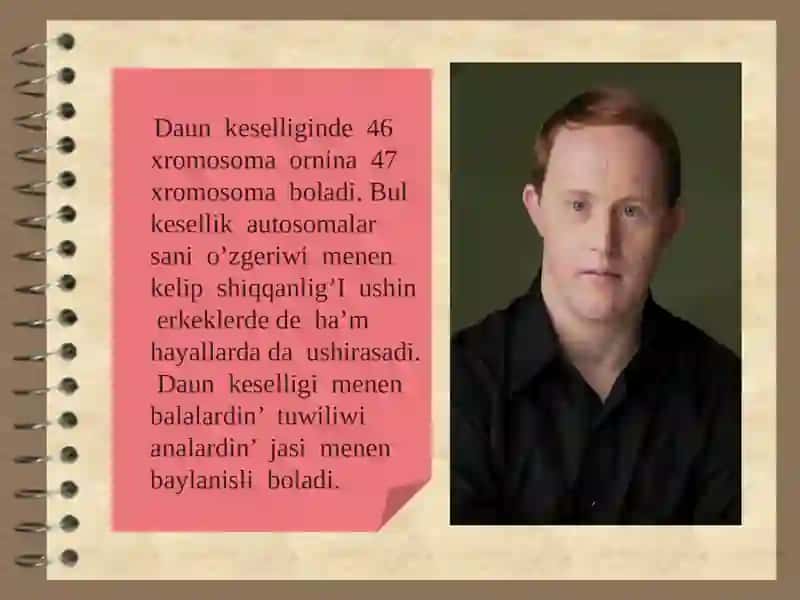 Xromosoma kesellikleri, Daun sindromi 3