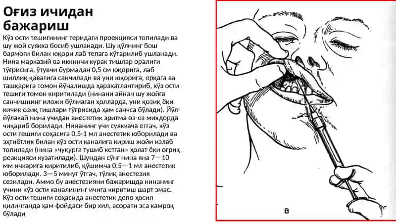 Стоматологиядаги огрик,сизлантиришлар: инфраорбитал, инцизивал, платинал 3