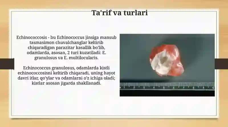 Ekinokokkozepidemiologiyasi, profilaktikasi va epidemiyaga qarshi chora-tadbirlar 3