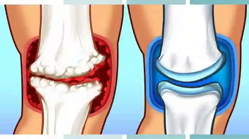 Osteoartritnima 3