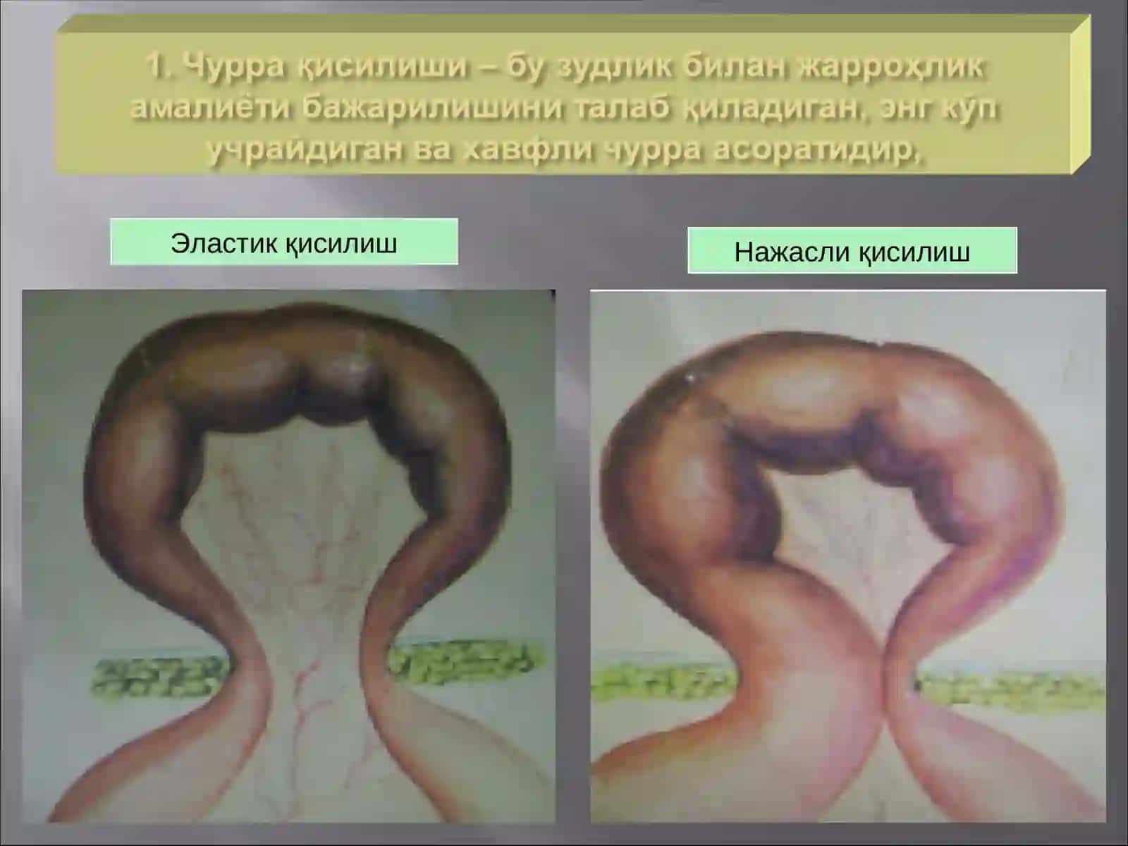 Қисилиш 3