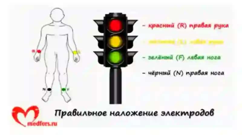 ЭКГ асослари 3