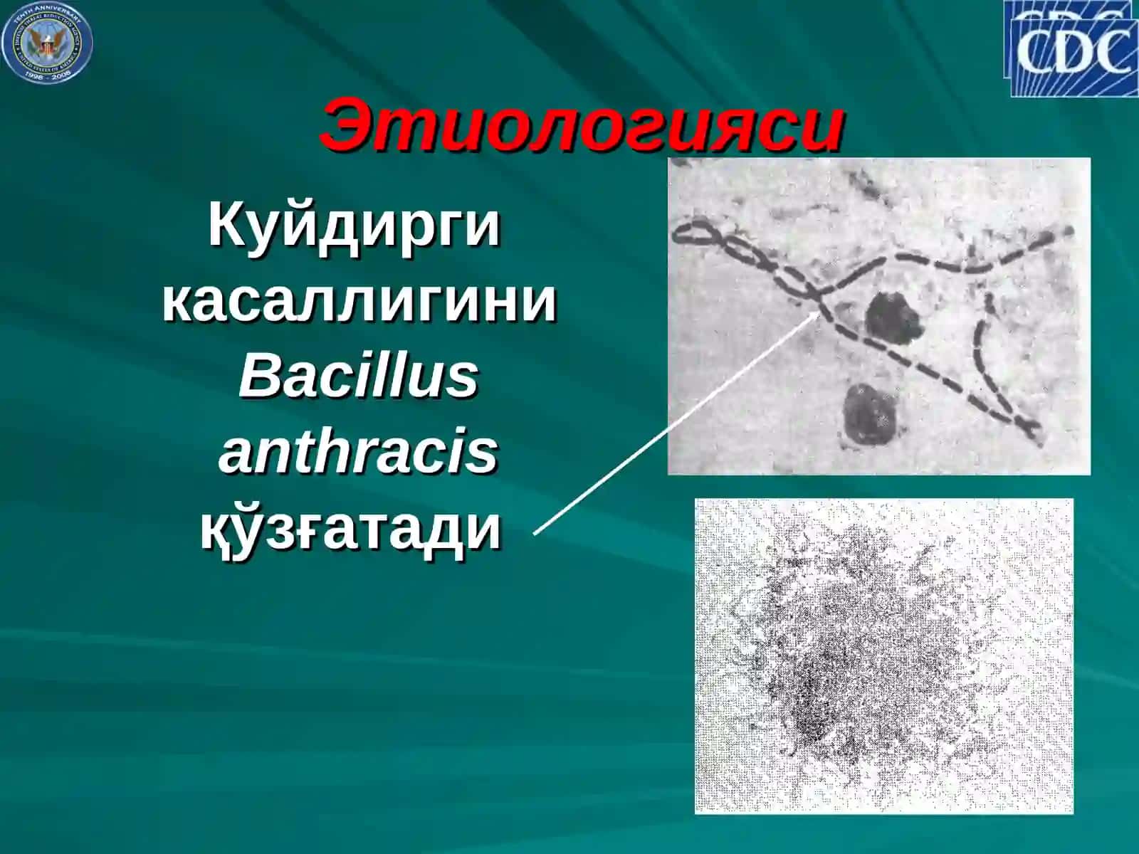 Куйдирги (сибир яраси, ёмон сифатли карбункул) 3