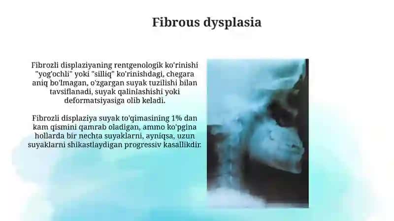 Fibrozli Displaziya 3