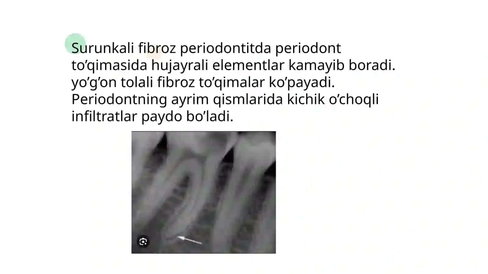 Surunkali periodontitning patologik anatomiyasi 3