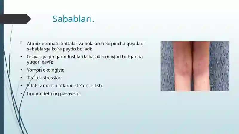 Atopik dermatitlar 3