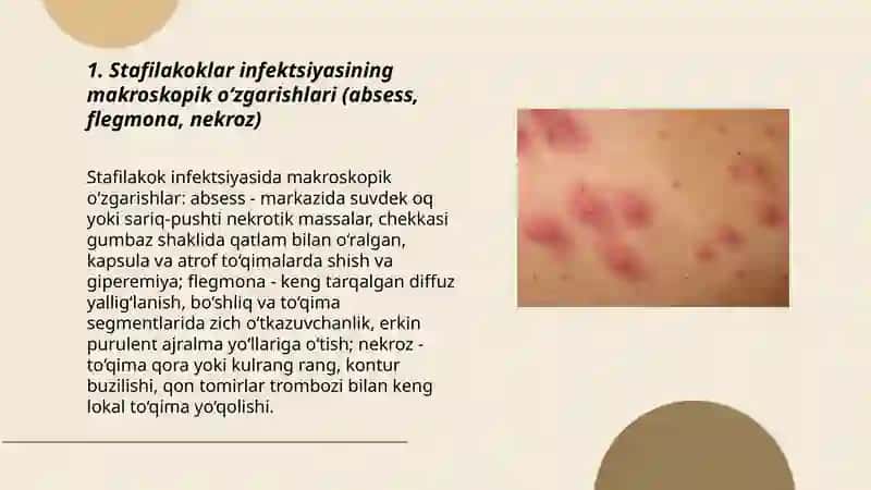 Stafilakoklar patalogik anatomiyasi 3