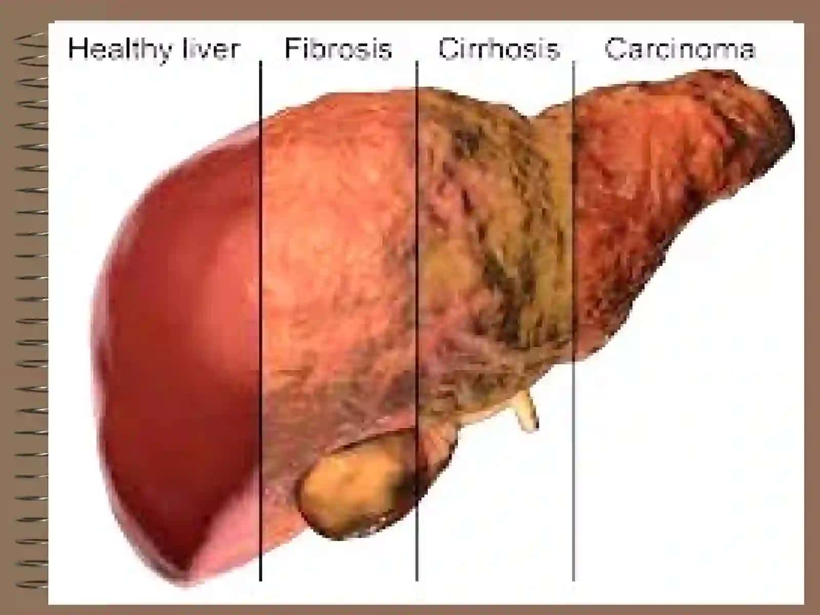 JIGAR PATOFIZIOLOGIYASI 3