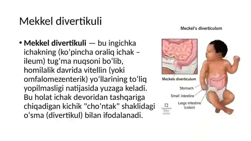 Mekkel Divertikulimi 3