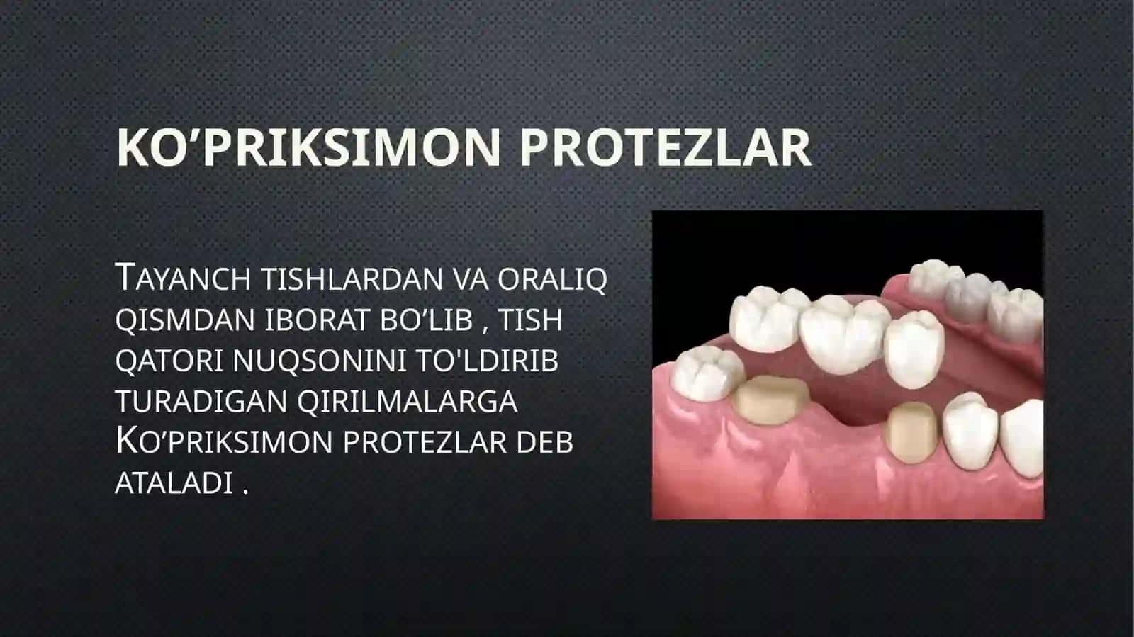 Zamonaviy Ko'priksimon protezlar 3