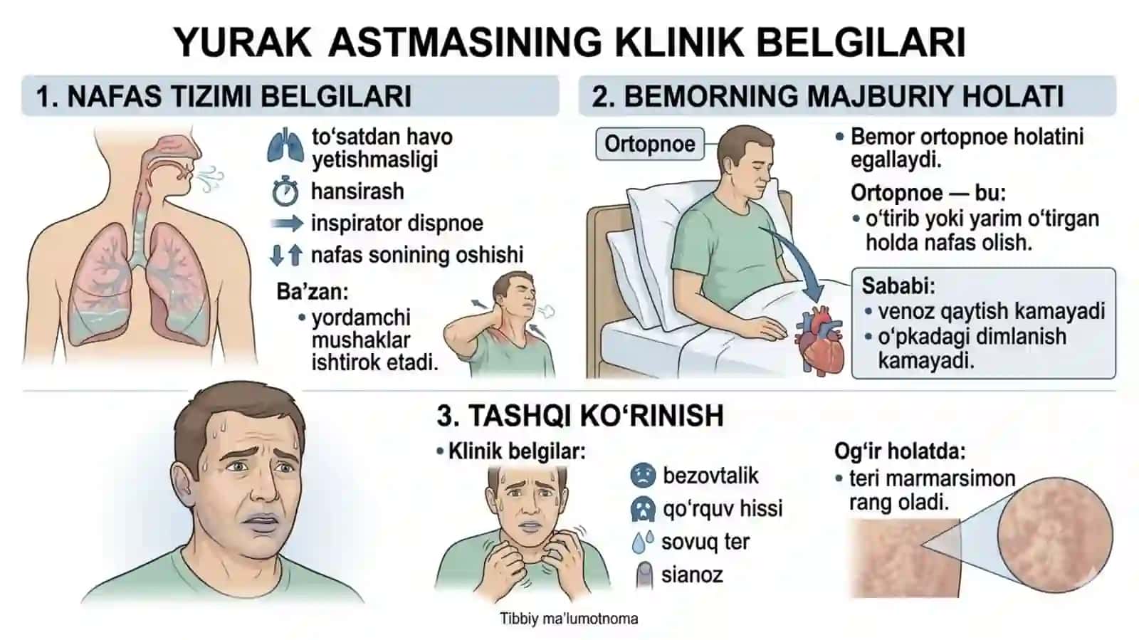 O'pka shishi va yurak astmasi 3