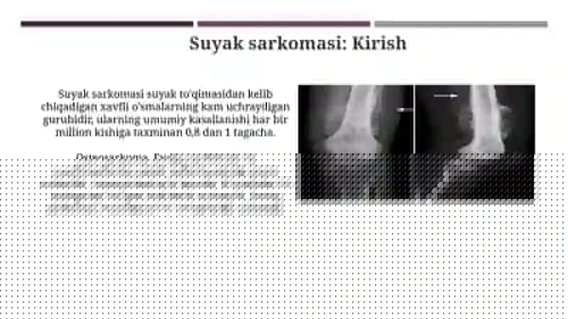 Suyak sarkomasi 3