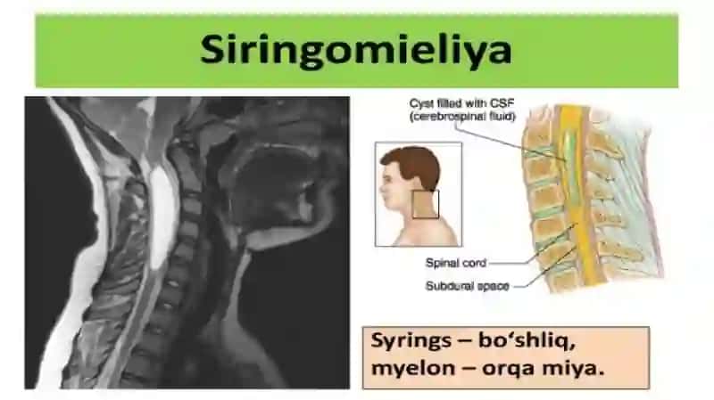 Siringomiyeliya 3