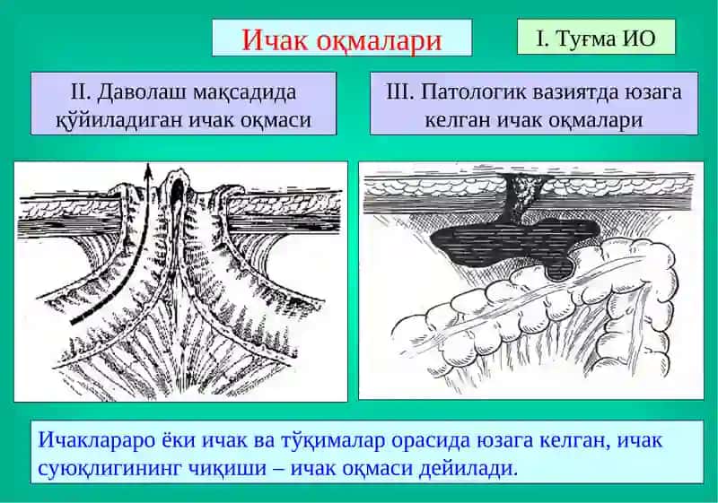 Ичак оқмалари 3