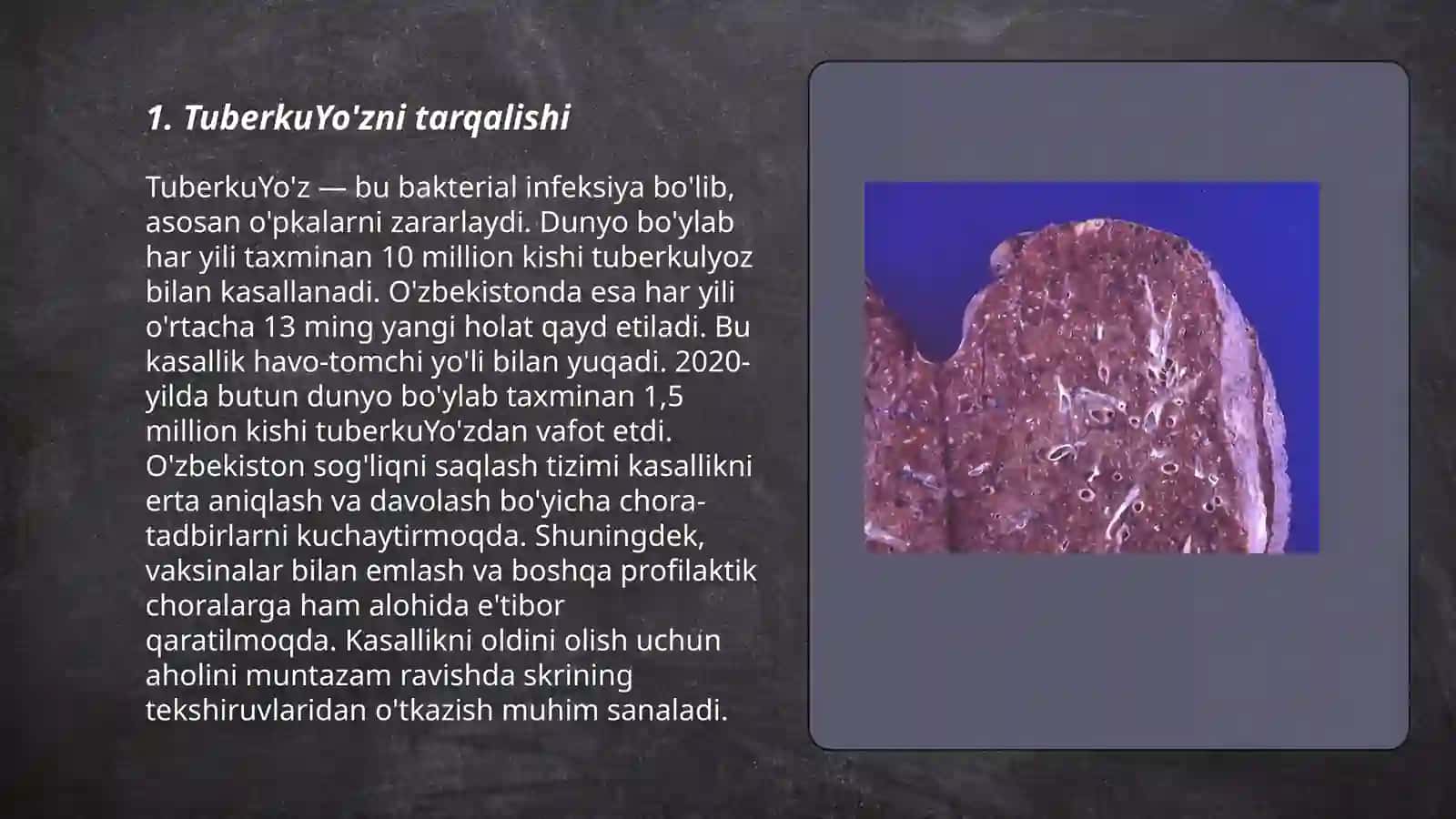 Tuberkulyoz 3