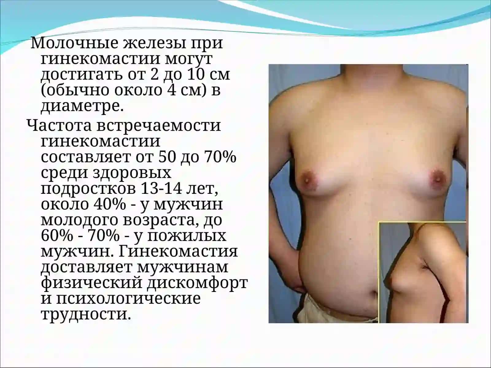 Гинекомастия 3