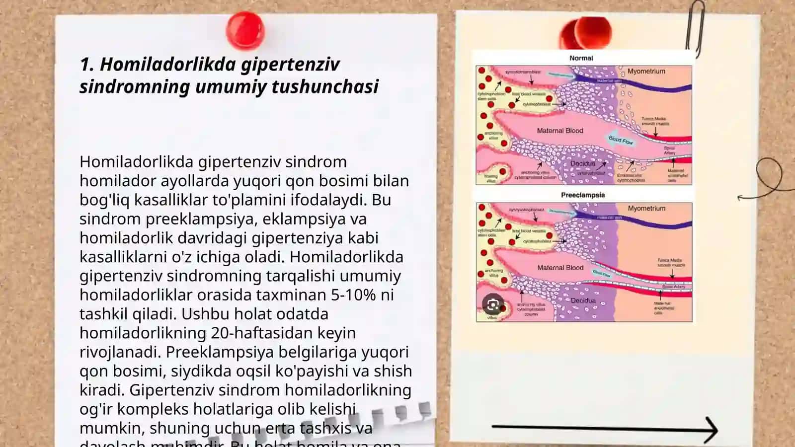 Gipertenziv sindromning homiladorlik davridagi asosiy turlari 3